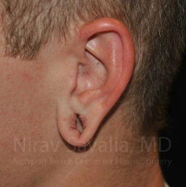 Torn Earlobe Repair Ear Gauge Repair Before & After Gallery - Patient 1655727 - Before