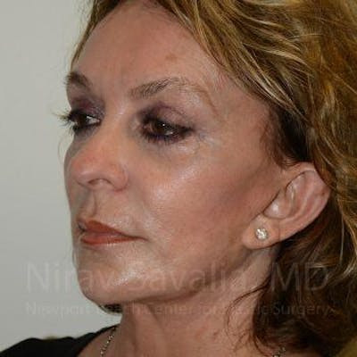 Fat Grafting to Face Before & After Gallery - Patient 1655730 - After