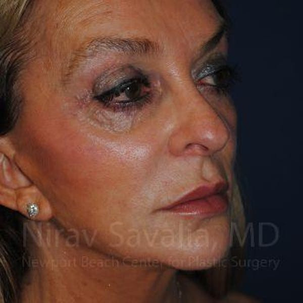 Fat Grafting to Face Before & After Gallery - Patient 1655730 - Before