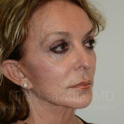 Eyelid Surgery Before & After Gallery - Patient 1655730 - After