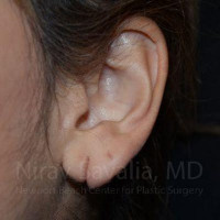 Torn Earlobe Repair Ear Gauge Repair Before & After Gallery - Patient 1655729 - Image 1