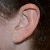 Torn Earlobe Repair Ear Gauge Repair Before & After Gallery - Patient 1655729 - Image 2