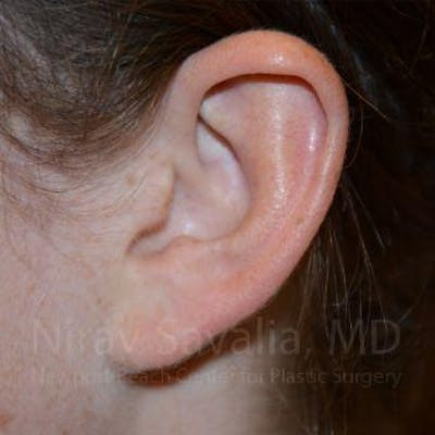 Torn Earlobe Repair Ear Gauge Repair Before & After Gallery - Patient 1655729