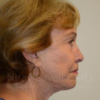Facelift Before & After Gallery - Patient 1655786 - Image 2