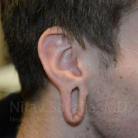 Torn Earlobe Repair Ear Gauge Repair Before & After Gallery - Patient 1655788 - Image 1