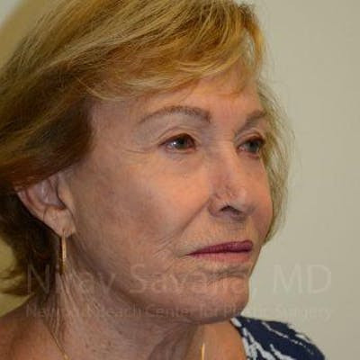 Facelift Before & After Gallery - Patient 1655786 - After