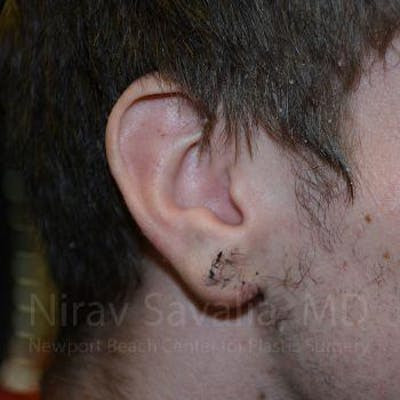 Torn Earlobe Repair Ear Gauge Repair Before & After Gallery - Patient 1655788 - After