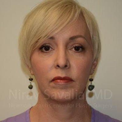 Mastectomy Reconstruction Revision Before & After Gallery - Patient 1655787