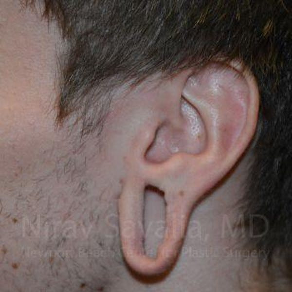 Torn Earlobe Repair Ear Gauge Repair Before & After Gallery - Patient 1655788 - Before