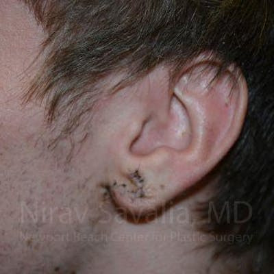 Chin Implants Before & After Gallery - Patient 1655788 - After