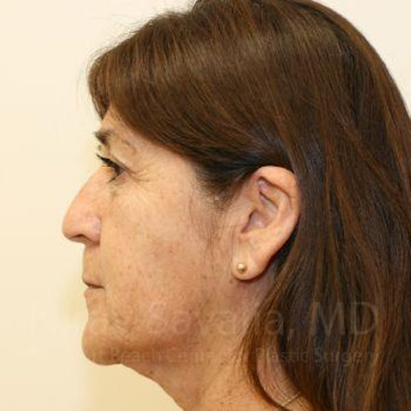 Eyelid Surgery Before & After Gallery - Patient 1655793 - Before