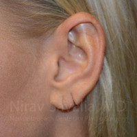 Torn Earlobe Repair Ear Gauge Repair Before & After Gallery - Patient 1655792 - Image 1