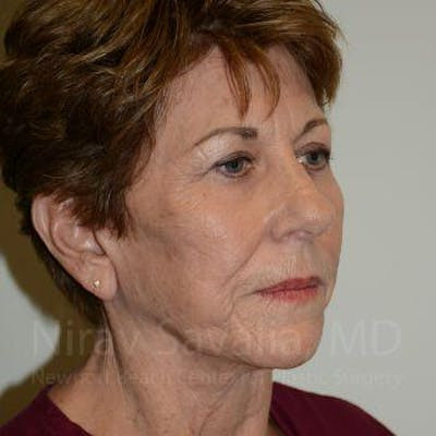 Facelift Before & After Gallery - Patient 1655791 - After