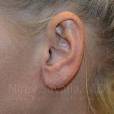 Torn Earlobe Repair Ear Gauge Repair Before & After Gallery - Patient 1655792 - After