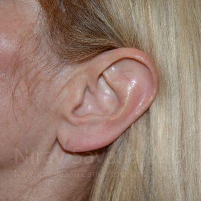 Torn Earlobe Repair Ear Gauge Repair Before & After Gallery - Patient 1655794 - Before