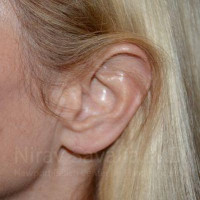 Torn Earlobe Repair Ear Gauge Repair Before & After Gallery - Patient 1655794 - Image 2