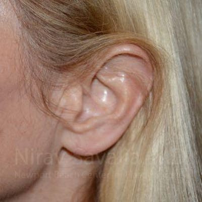 Torn Earlobe Repair Ear Gauge Repair Before & After Gallery - Patient 1655794 - After