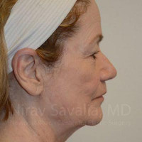 Facelift Before & After Gallery - Patient 1655795 - Image 1