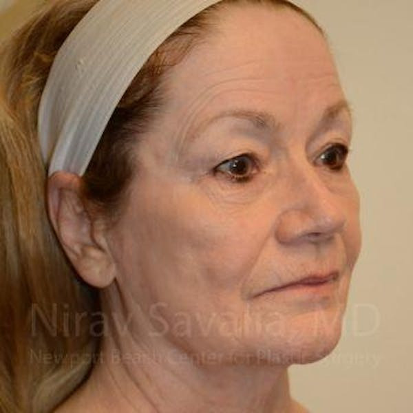 Facelift Before & After Gallery - Patient 1655795 - Before