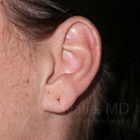 Torn Earlobe Repair Ear Gauge Repair Before & After Gallery - Patient 1655797 - Image 1