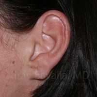 Torn Earlobe Repair Ear Gauge Repair Before & After Gallery - Patient 1655797 - Image 2