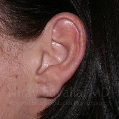 Torn Earlobe Repair Ear Gauge Repair Before & After Gallery - Patient 1655797