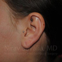 Torn Earlobe Repair Ear Gauge Repair Before & After Gallery - Patient 1655798 - Image 1
