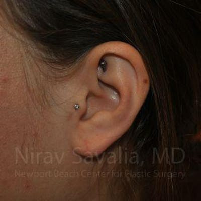 Torn Earlobe Repair Ear Gauge Repair Before & After Gallery - Patient 1655798