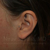 Torn Earlobe Repair Ear Gauge Repair Before & After Gallery - Patient 1655798 - Image 2