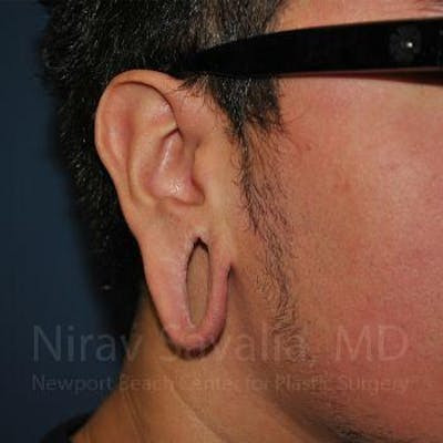 Torn Earlobe Repair Ear Gauge Repair Before & After Gallery - Patient 1655801 - Before