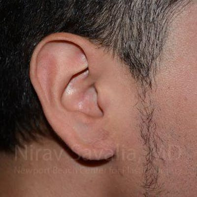 Torn Earlobe Repair Ear Gauge Repair Before & After Gallery - Patient 1655801