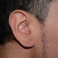 Torn Earlobe Repair Ear Gauge Repair Before & After Gallery - Patient 1655801 - Image 2