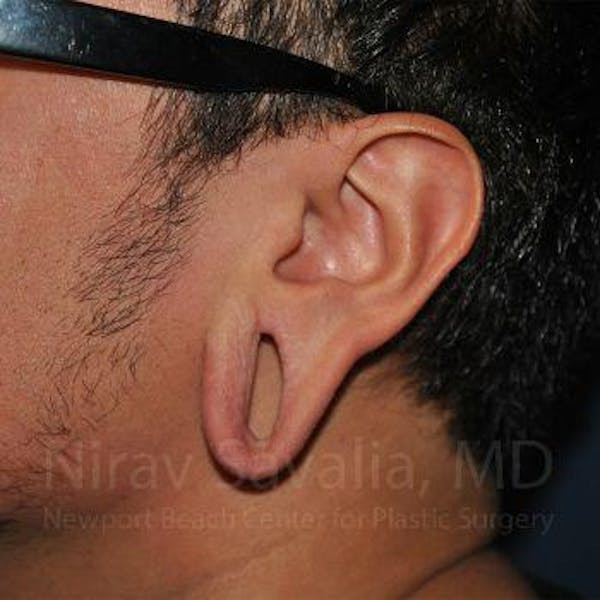 Torn Earlobe Repair Ear Gauge Repair Before & After Gallery - Patient 1655801 - Before