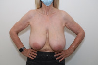 Breast Reduction Before & After Gallery - Patient  - Image 1